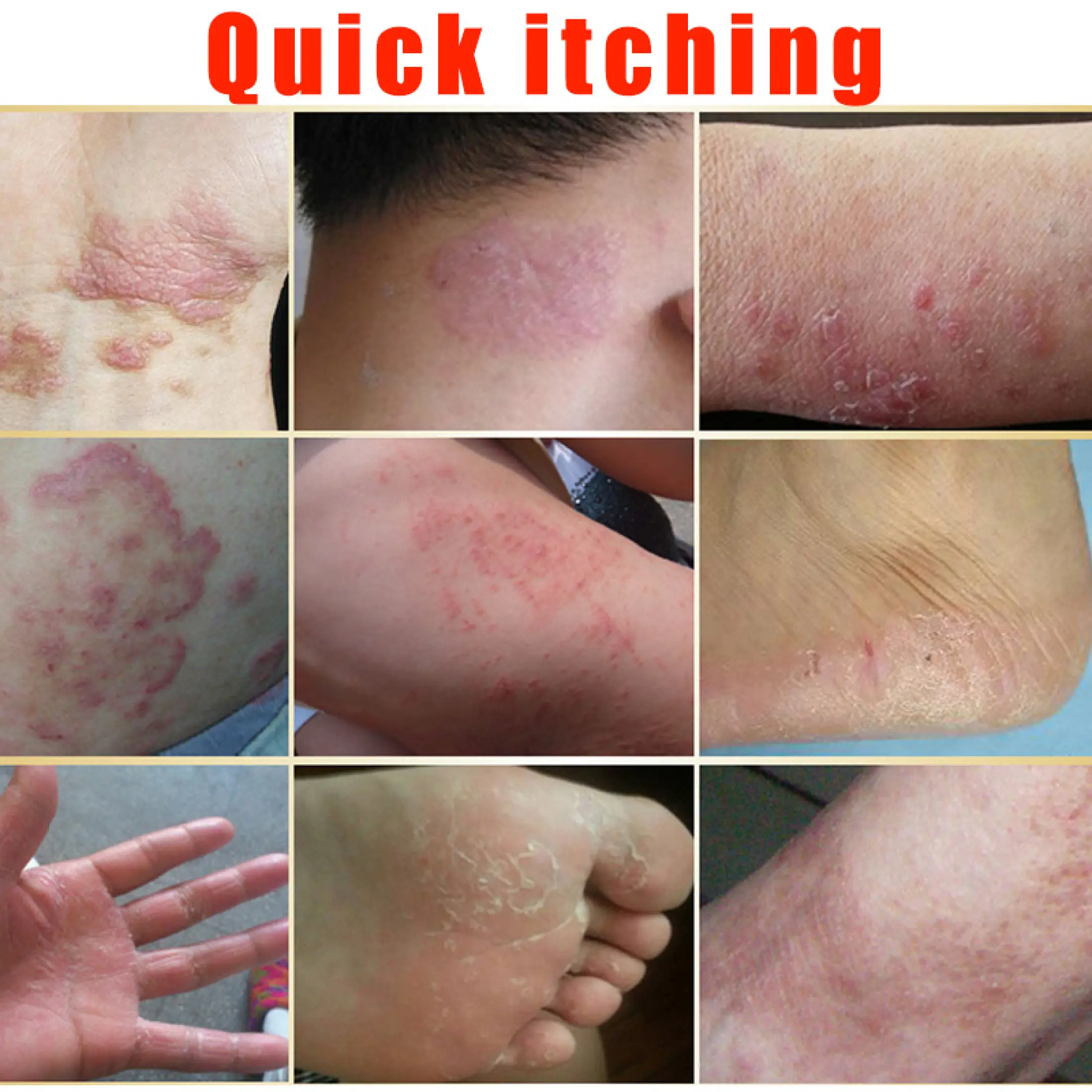 Ready Stock 10pcs Chinese Herbal Eczema Psoriasis Cream Ointment For Skin Disease Rashes Natural Body Dermatitis Pruritus Relief For Rashes Lazada Singapore